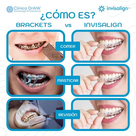 que es brackets Invisalign